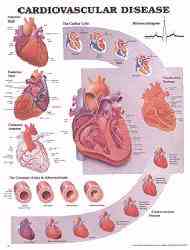 Ideal aid for explaining cardiovasuclar disease to patients
