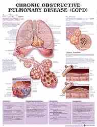 Chart makes explaining COPD to patients easy